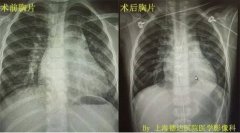 上海德达医院快速康复通道 为4岁先心病儿童